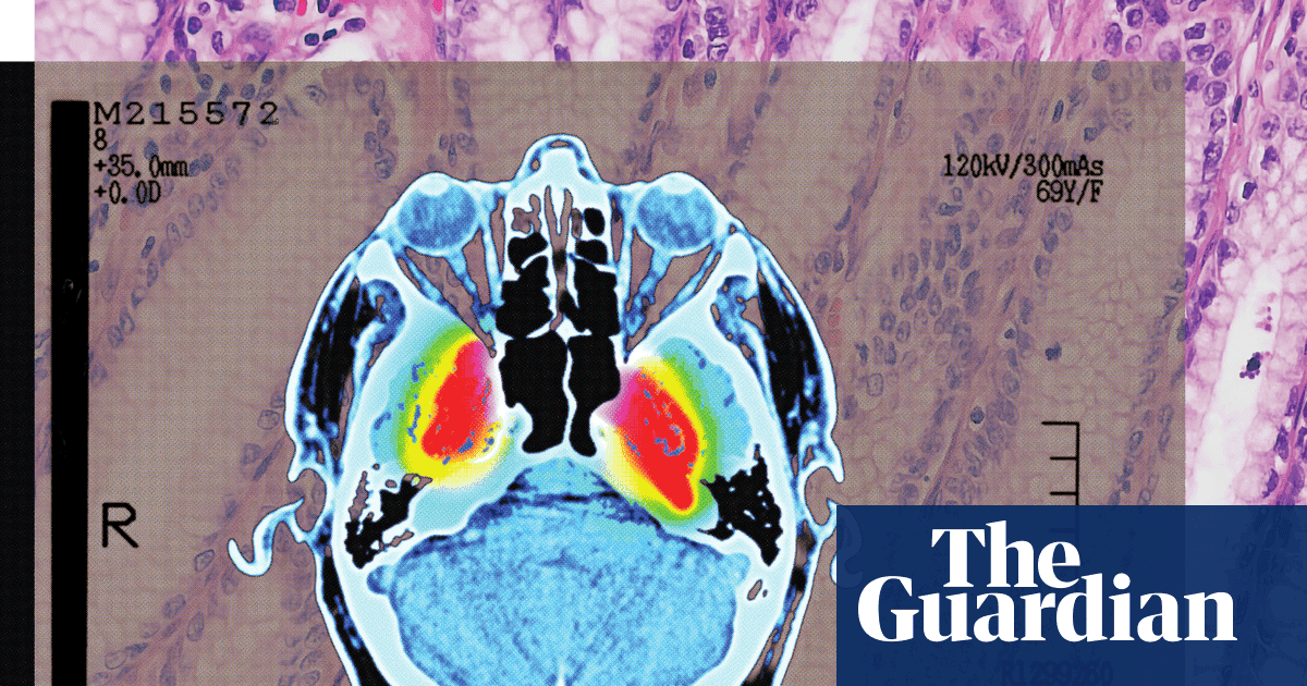 How the Shingles Vaccine May Do More Than Prevent Shingles — Including Lowering Dementia Risk