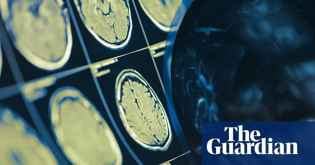 Brain Artery Widening — Not Blockages — May Be the True Cause of Lacunar Strokes