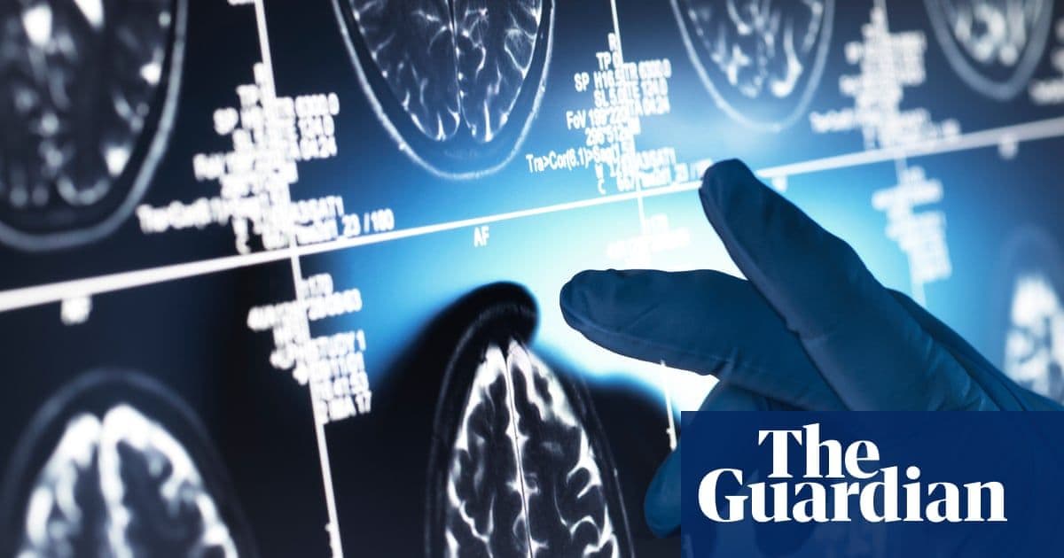 Hyped Alzheimer's Treatments Deliver 'Trivial' Benefits, Major Review Finds