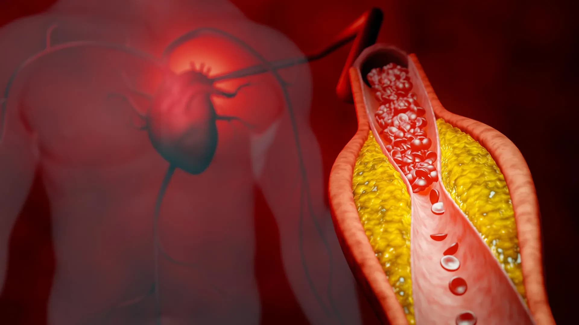 Are Millions of Americans Getting the Wrong Cholesterol Test?