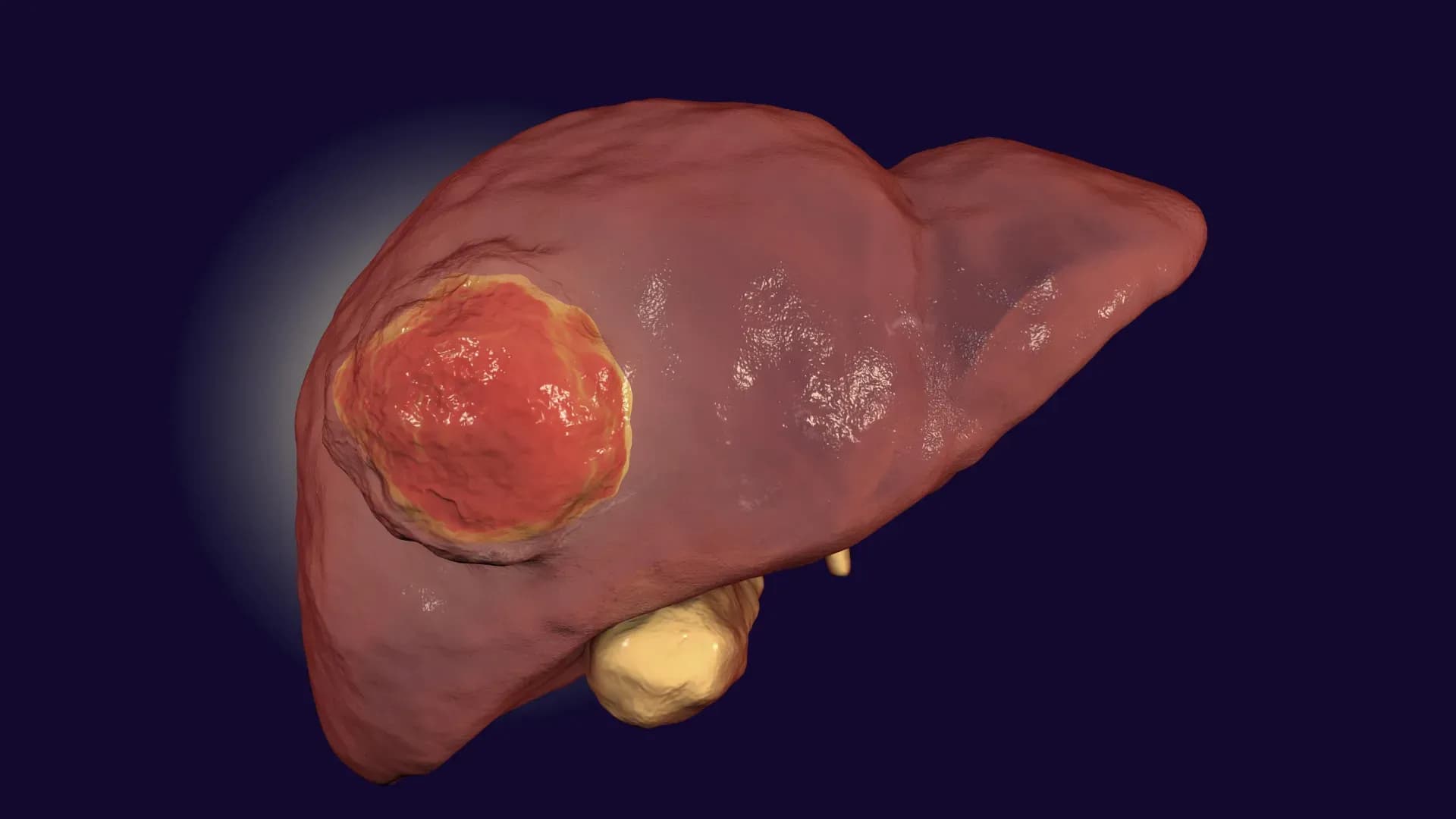 FDA-Approved Drug Unlocks Immunotherapy's Potential Against Rare Liver Cancer