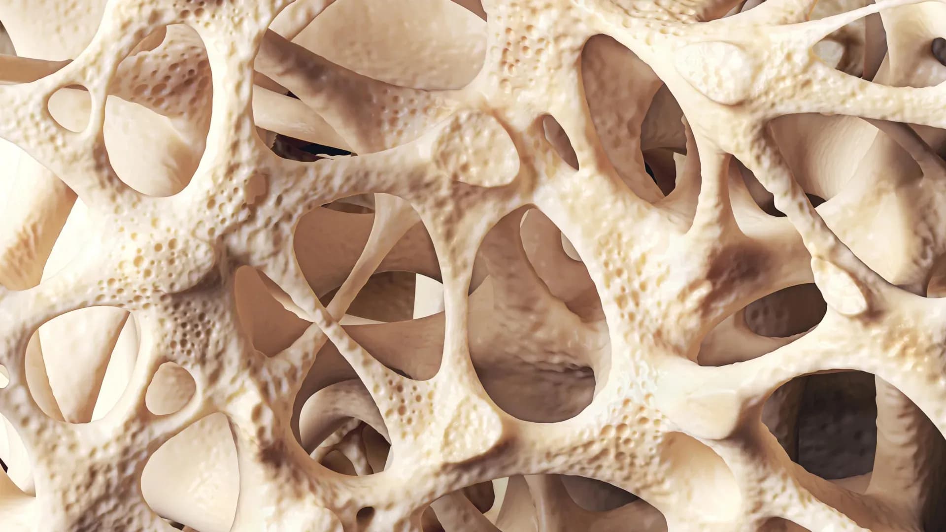 The Silent Bone Thief: How Osteopenia Is Affecting Millions Without Warning