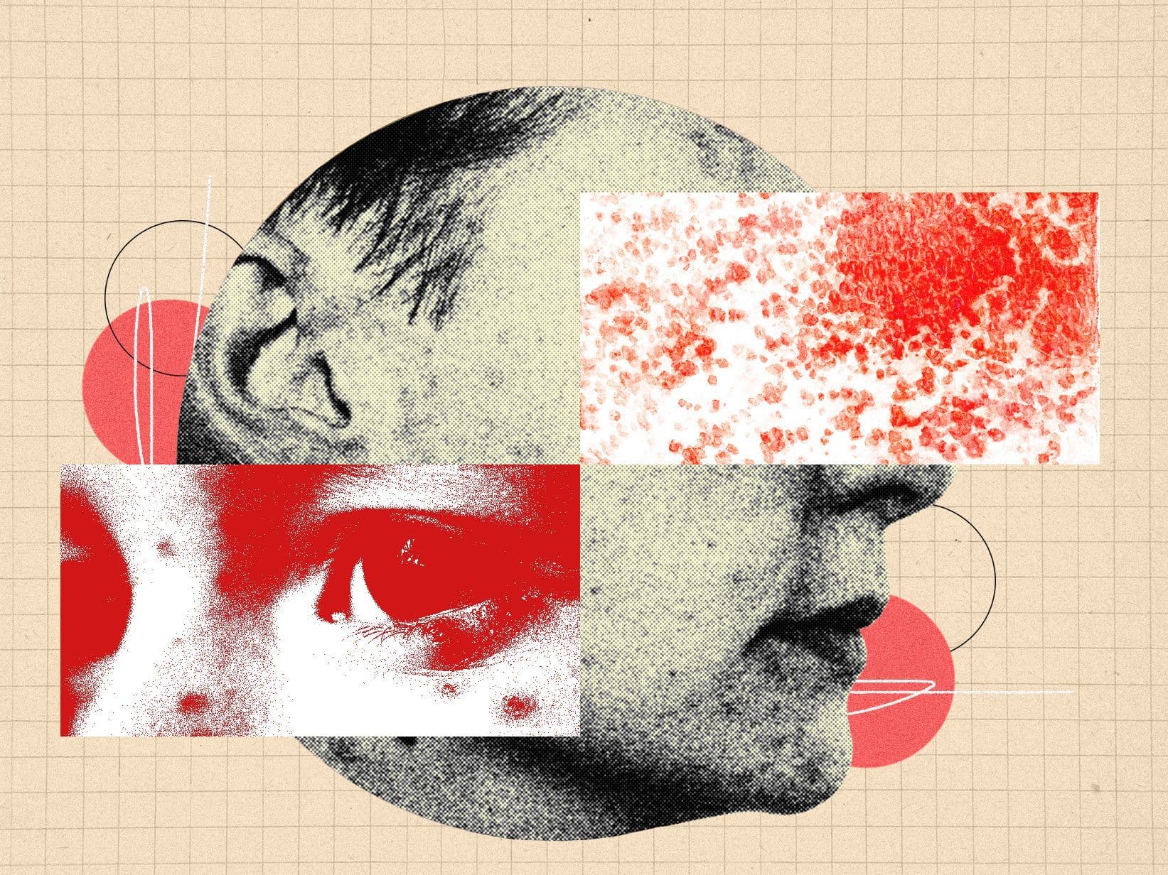 Why Shingles Is Far More Dangerous Than Most People Realize