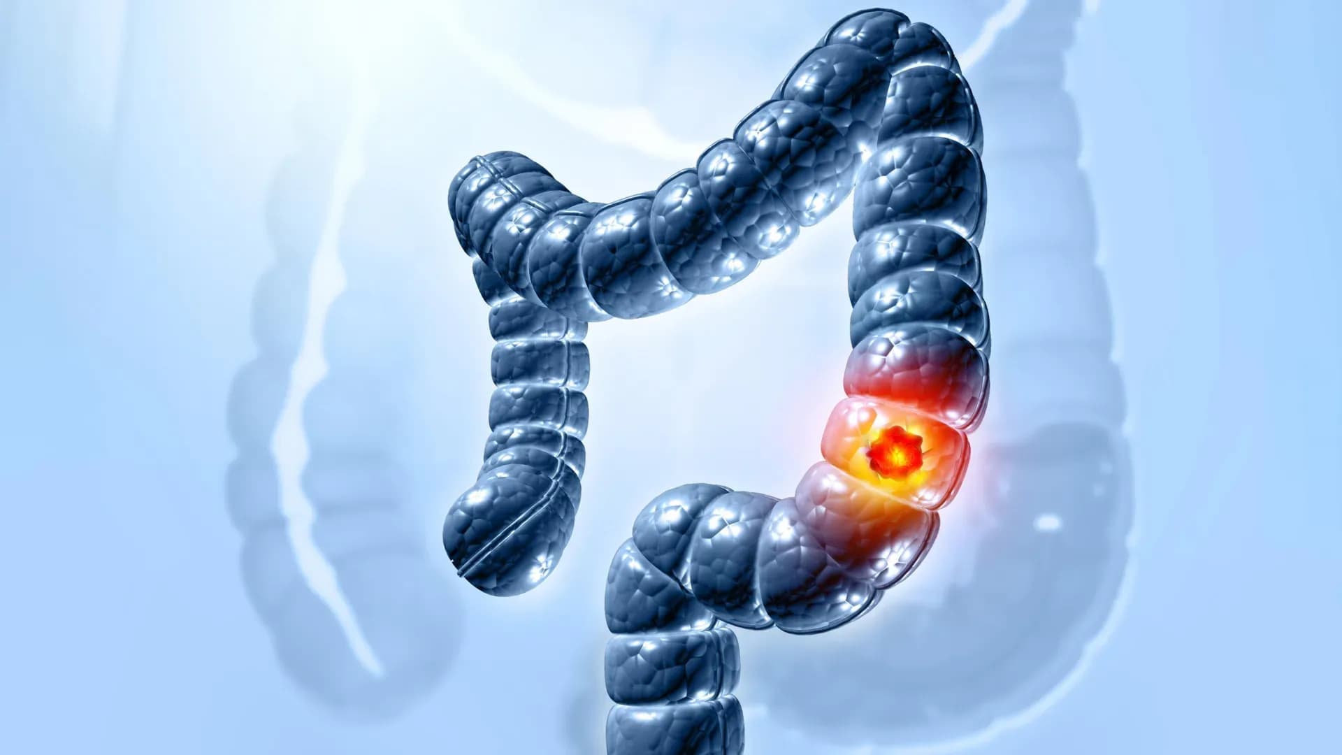 Mystery Solved: How a Common Gut Bacterium Hijacks Colon Cells to Trigger Cancer